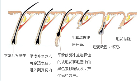 冰点脱毛有副作用吗