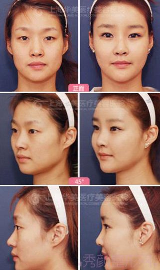 上海华美李健做全脸自体脂肪填充怎么样？