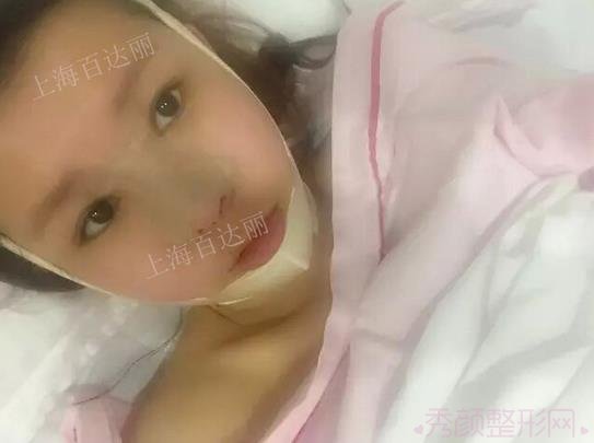在上海百达丽做了肋软骨隆鼻修复+硅胶假体下巴