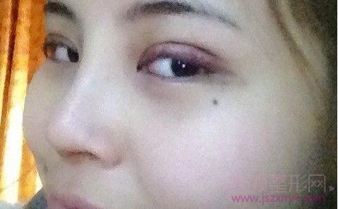 武汉双眼皮和假体隆鼻手术的一些心得分享