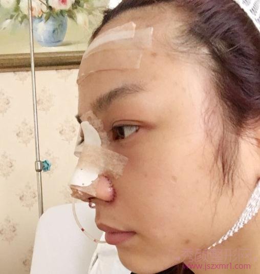 广州鼻部手术隆鼻，两个月恢复分享