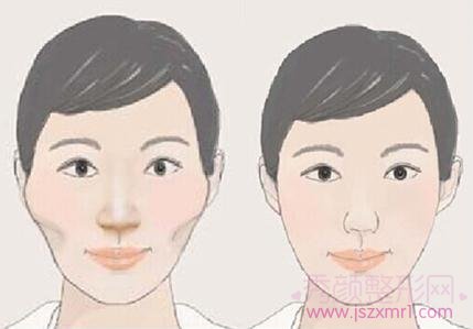 上海磨骨改脸型整容手术多少钱?
