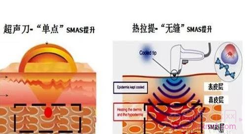 热拉提和超声提拉哪个好,有什么区别