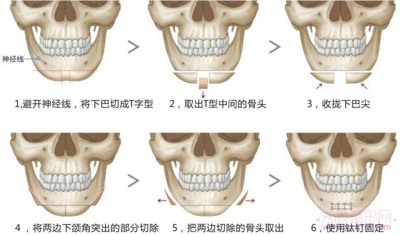 V-Line和下颌角磨骨有什么区别?