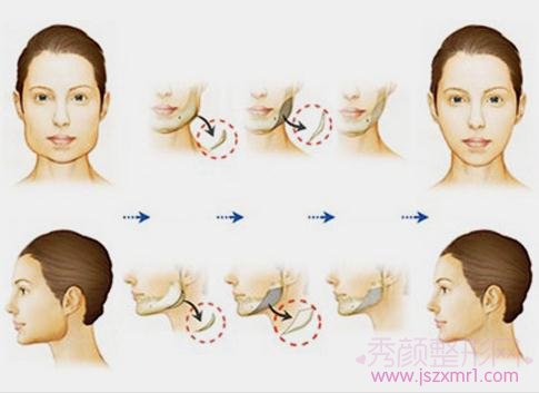 V-Line和下颌角磨骨有什么区别?