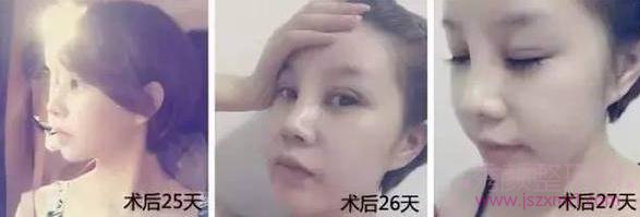 杭州美莱做的双眼皮和隆鼻,怎么样~