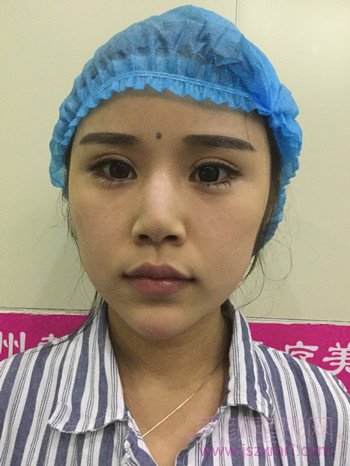 在郑州都市风韵做的鼻部手术已经72天了