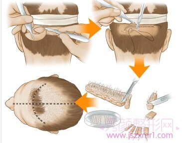 【关于植发】你所不知道的植发全过程~~~~~~~~~