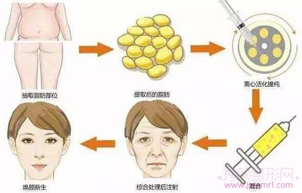 改良面部不饱满,自体脂肪VS玻尿酸,究竟哪个好