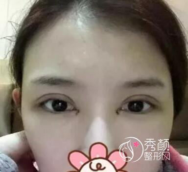 北京双眼皮修复案例分享。