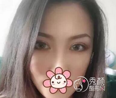 北京双眼皮修复案例分享。