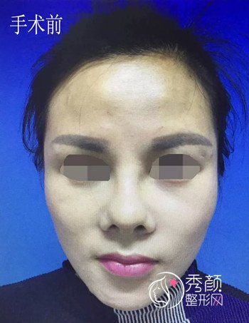 上海九院韦敏鼻部手术修复+下巴整形案例