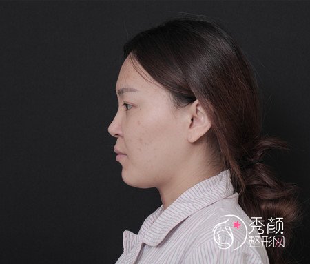 北京沃尔刘彦军肋软骨隆鼻怎么样,案例图。