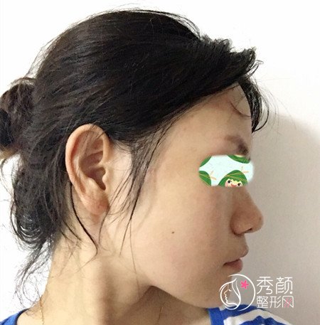 上海华山医院穆雄铮下颌角整形案例。