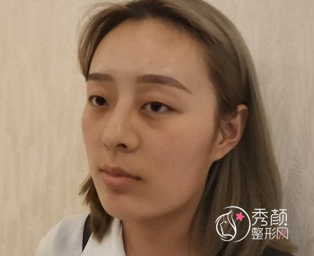 杭州时光下颌角磨骨+隆鼻+割双眼皮案例一枚。