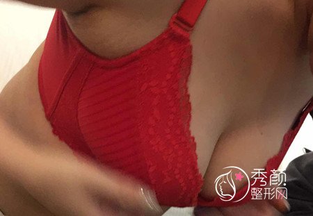 北京邦定陈育哲隆胸修复怎么样,案例分享。