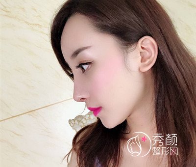 上海九院陈付国肋软骨隆鼻修复案例。