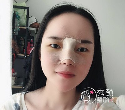 长沙爱思特肋软骨鼻部手术案例。