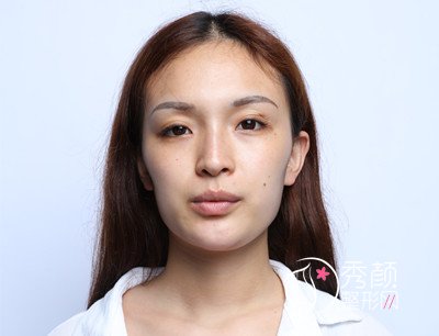 长沙亚韩双眼皮修复案例分享。