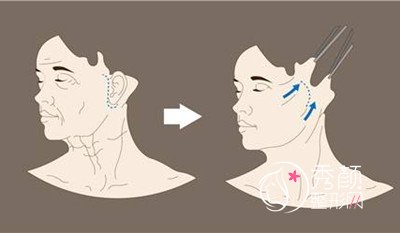 面部除皱：埋线提升悬吊、“大拉皮”和“小拉皮”