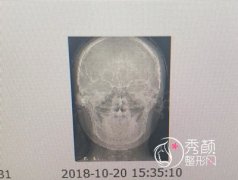 上海首爾麗格崔榮達顴骨顴弓和下頜角整形案例
