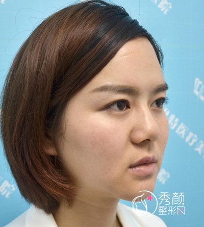 武汉希思特杨权明鼻部手术案例。