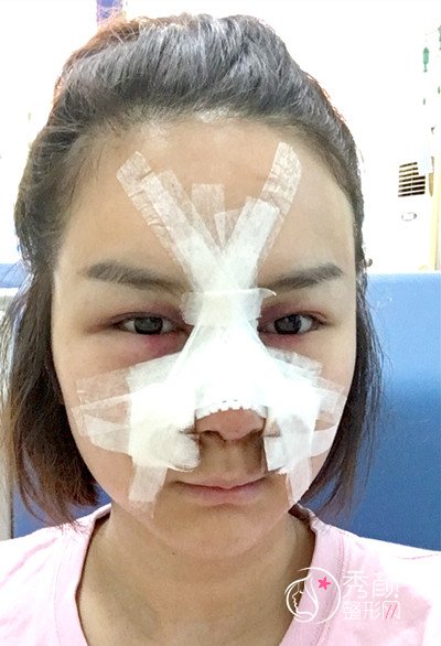武汉希思特杨权明鼻部手术案例。