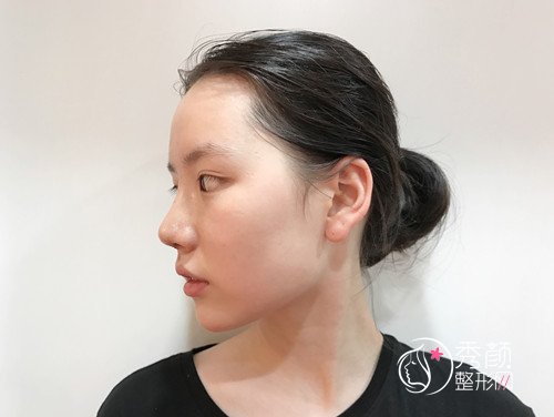 上海华美徐文龙隆鼻怎么样,案例分享。