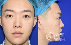 上海男士肋軟骨隆鼻案例，恢復好了也是大帥哥一枚！