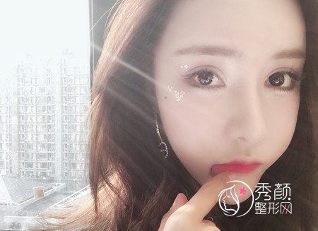 上海玫瑰赵延峰半肋软骨鼻部手术修复案例。