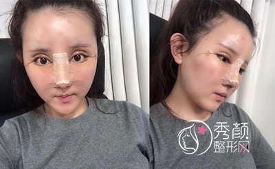 北京玲珑梵宫眼鼻部手术修复案例分享。