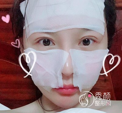 上海首尔丽格双眼皮修复（眼部手术）案例。