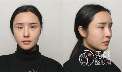 北京叶子整形鲁礼新割双眼皮案例分享。