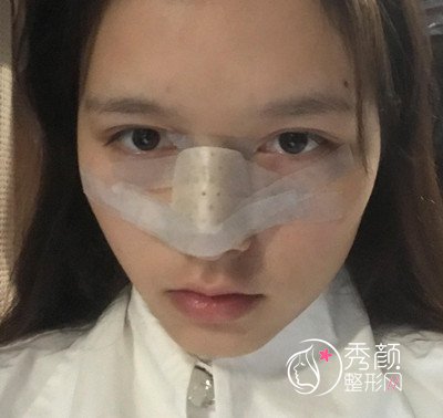 重庆联合丽格党宁鼻部手术整形案例分享。