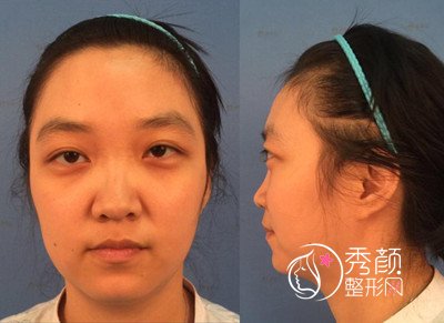 北京整形医生曾高隆鼻怎么样,真实案例分享。
