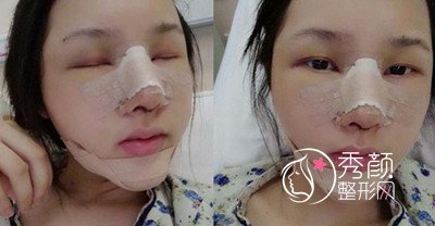 广州美莱罗延平鼻部手术怎么样,真实案例分享。