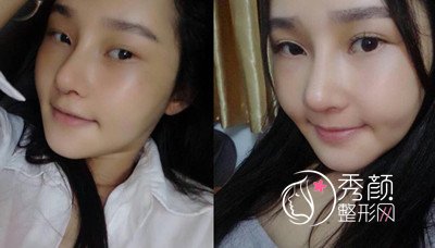 广州美莱罗延平鼻部手术怎么样,真实案例分享。