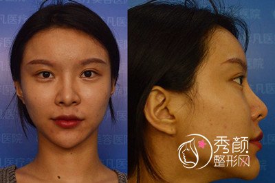 深圳非凡隆鼻怎么样,鼻部手术案例分享。