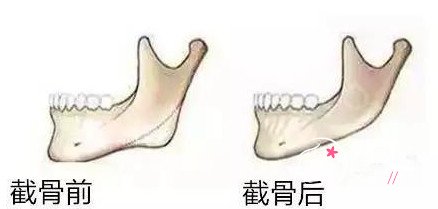 上海哪个三甲医院磨骨好，大概需要多少钱