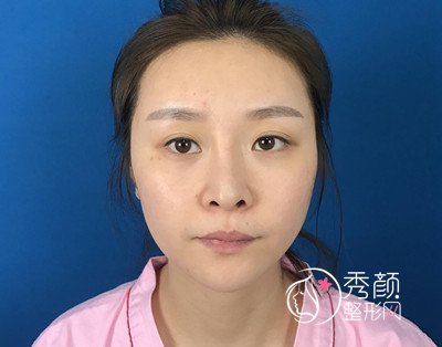 上海伯思立顾清鼻修复和全脸脂肪填充案例分享