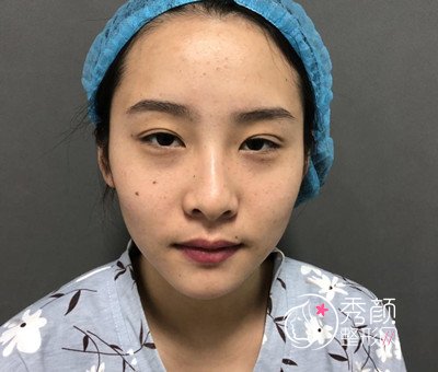 武汉禾丽整形眼部手术+全脸脂肪填充案例。