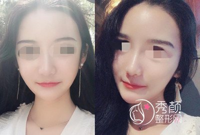 北京清木整形马梅生颧弓吸脂手术案例。