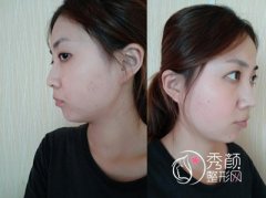 昆明延安醫院鄭延清下頜角磨骨案例。