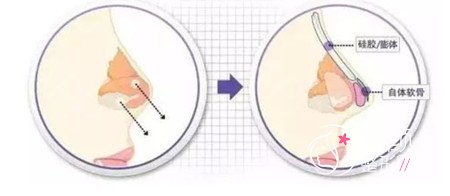 都已经开腔取肋，为什么还要分半肋和全肋骨鼻