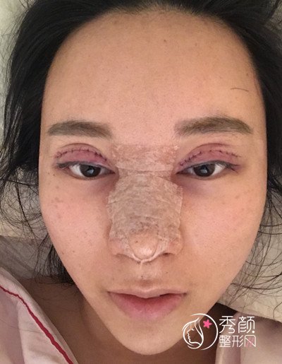 上海百达丽徐晓斐双眼皮修复+隆鼻案例。