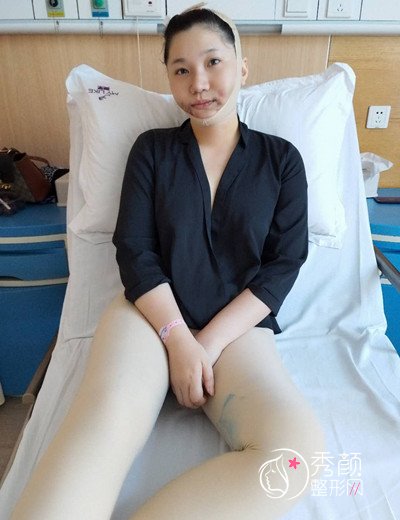 袁玉坤自体脂肪隆胸案例。