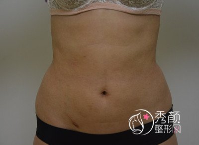 北京禾美嘉全身吸脂+脂肪填充面部案例。