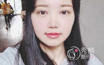 上海盈美杨璐眼部手术手术后一个月案例。