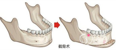 磨骨手术有哪些后遗症,怎样预防磨骨后遗症?