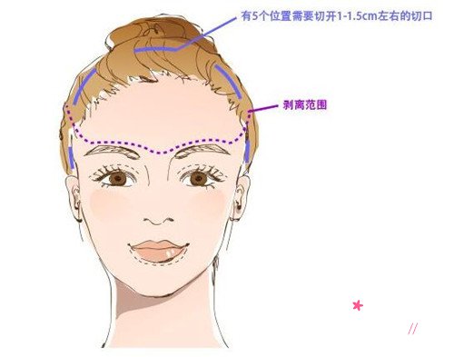 内窥镜手术除皱果到底咋样,需要多少钱?